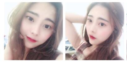 上海首爾麗格整形醫(yī)生魯峰一做自體脂肪全臉填充 上海首爾麗格整形醫(yī)生魯峰一做自體脂肪全臉填充