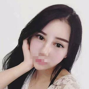 東莞維多利亞做硅膠隆鼻怎么樣？整形醫(yī)生李剛硅膠隆鼻案例分享