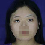 上海亞太醫(yī)療專家周聰做雙眼皮怎么樣？附周聰醫(yī)生雙眼皮案例