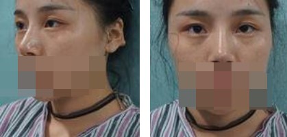 寧波美仁整形美容醫(yī)院李英大醫(yī)生做切開雙眼皮效果怎么樣？