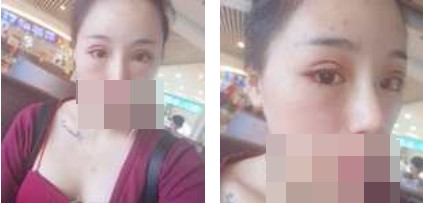 寧波美仁整形美容醫(yī)院李英大醫(yī)生做切開雙眼皮效果怎么樣？