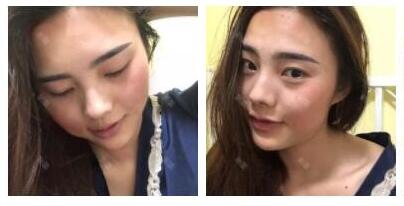 上海首爾麗格整形醫(yī)生魯峰一做自體脂肪全臉填充 上海首爾麗格整形醫(yī)生魯峰一做自體脂肪全臉填充