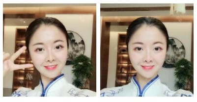 深圳嶺南醫(yī)院整形醫(yī)生丁祖鑫做假體豐太陽(yáng)穴案例效果對(duì)比圖 深圳嶺南醫(yī)院整形醫(yī)生丁祖鑫做假體豐太陽(yáng)穴案例效果對(duì)比圖