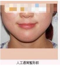 整形醫(yī)生張波濤酒窩成形術(shù)案例