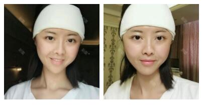 深圳嶺南醫(yī)院整形醫(yī)生丁祖鑫做假體豐太陽(yáng)穴案例效果對(duì)比圖 深圳嶺南醫(yī)院整形醫(yī)生丁祖鑫做假體豐太陽(yáng)穴案例效果對(duì)比圖