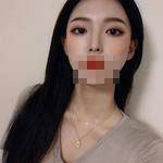 蘇州愛思特醫(yī)療美容醫(yī)院翟奔宇醫(yī)生肋軟骨隆鼻案例效果對比圖