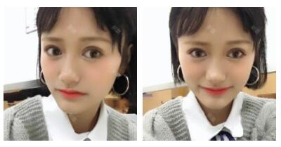 東莞華美做切開雙眼皮怎么樣？朱清武醫(yī)生切開雙眼皮案例分享