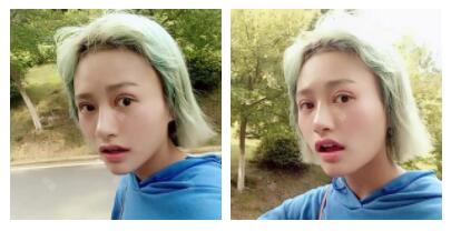 朱清武醫(yī)生切開(kāi)雙眼皮案例分享