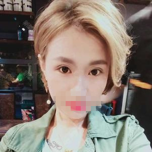 雙眼皮手術(shù)第十五天