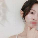 蘇州愛思特醫(yī)療美容醫(yī)院翟奔宇醫(yī)生肋軟骨隆鼻案例效果對比圖