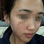 石家莊美然醫(yī)療整形醫(yī)生劉超做激光祛疤效果怎么樣？附劉超醫(yī)生案例