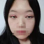 術(shù)后照片 術(shù)后照片