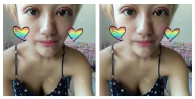 東莞華美做切開雙眼皮怎么樣？朱清武醫(yī)生切開雙眼皮案例分享