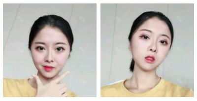 深圳嶺南醫(yī)院整形醫(yī)生丁祖鑫做假體豐太陽(yáng)穴案例效果對(duì)比圖 深圳嶺南醫(yī)院整形醫(yī)生丁祖鑫做假體豐太陽(yáng)穴案例效果對(duì)比圖