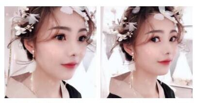 上海首爾麗格整形醫(yī)生魯峰一做自體脂肪全臉填充效果怎么樣？