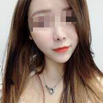 深圳尚虹醫(yī)療整形醫(yī)生藍(lán)劍雄做自體脂肪豐面頰效果怎么樣？附案例