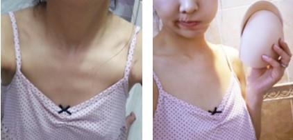 沈陽杏林整形美容醫(yī)院崔昌墉醫(yī)生做假體隆胸技術(shù)怎么樣？附案例