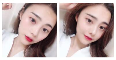 上海首爾麗格整形醫(yī)生魯峰一做自體脂肪全臉填充 上海首爾麗格整形醫(yī)生魯峰一做自體脂肪全臉填充