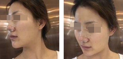 術(shù)后照片 術(shù)后照片