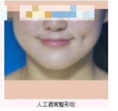 整形醫(yī)生張波濤酒窩成形術(shù)案例