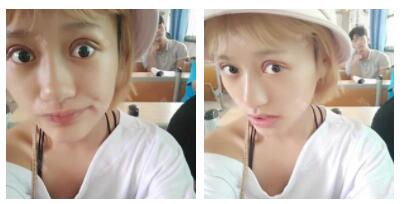 朱清武醫(yī)生切開(kāi)雙眼皮案例分享