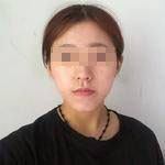 做完埋線提升后，松弛的臉蛋拜拜了