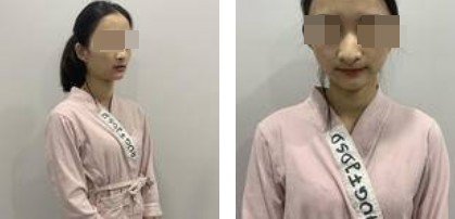 自體軟骨隆鼻案例