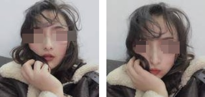 美麗自信的生活從自體軟骨隆鼻開始