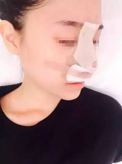 金奇龍膨體隆鼻案例展示