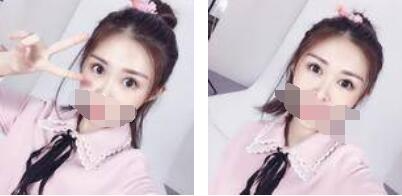 沒有了眼袋困擾，身體和心態(tài)都年輕了十歲