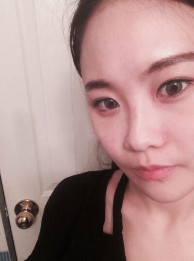 貴陽長江醫(yī)院整形美容中心韓盛斌醫(yī)生做自體脂肪隆鼻+全臉填充案例