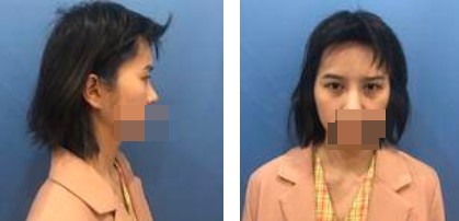 手術(shù)前的照片