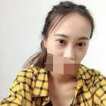 隆鼻+雙眼皮手術(shù)讓我成功蛻變，顏值達(dá)到巔峰