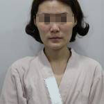 做完自體脂肪豐面頰后，我的面部比例更加完美了呢