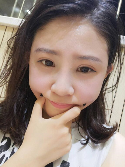 海南添美整形外科醫(yī)生王曉軍做自體軟骨隆鼻+雙眼皮+祛眼袋案例效果對比圖