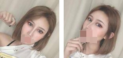 鼻綜合+眼綜合整形，讓我美的更自然，再也不用p圖了