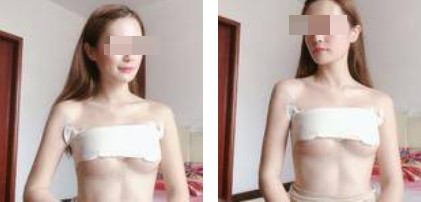 樸正淳假體隆胸案例分享