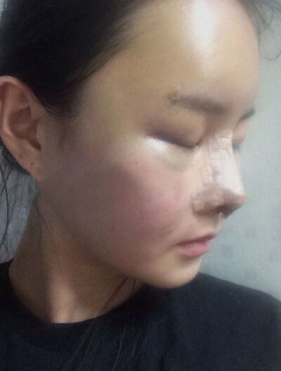 貴陽長江醫(yī)院整形美容中心韓盛斌醫(yī)生做自體脂肪隆鼻+全臉填充案例