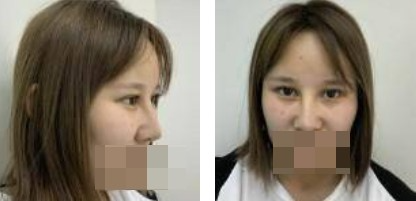 鼻綜合+眼綜合整形，讓我美的更自然，再也不用p圖了