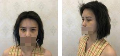 手術(shù)中的照片