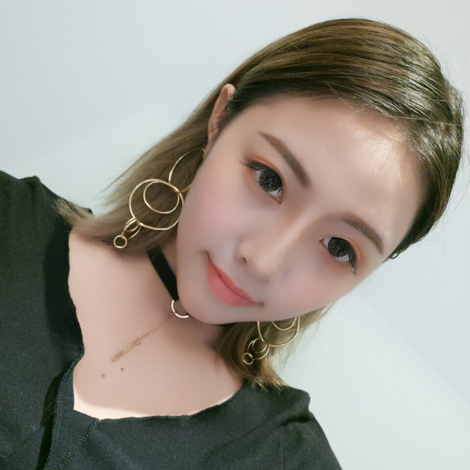 整形醫(yī)生徐長亮做切開雙眼皮案例效果對比圖