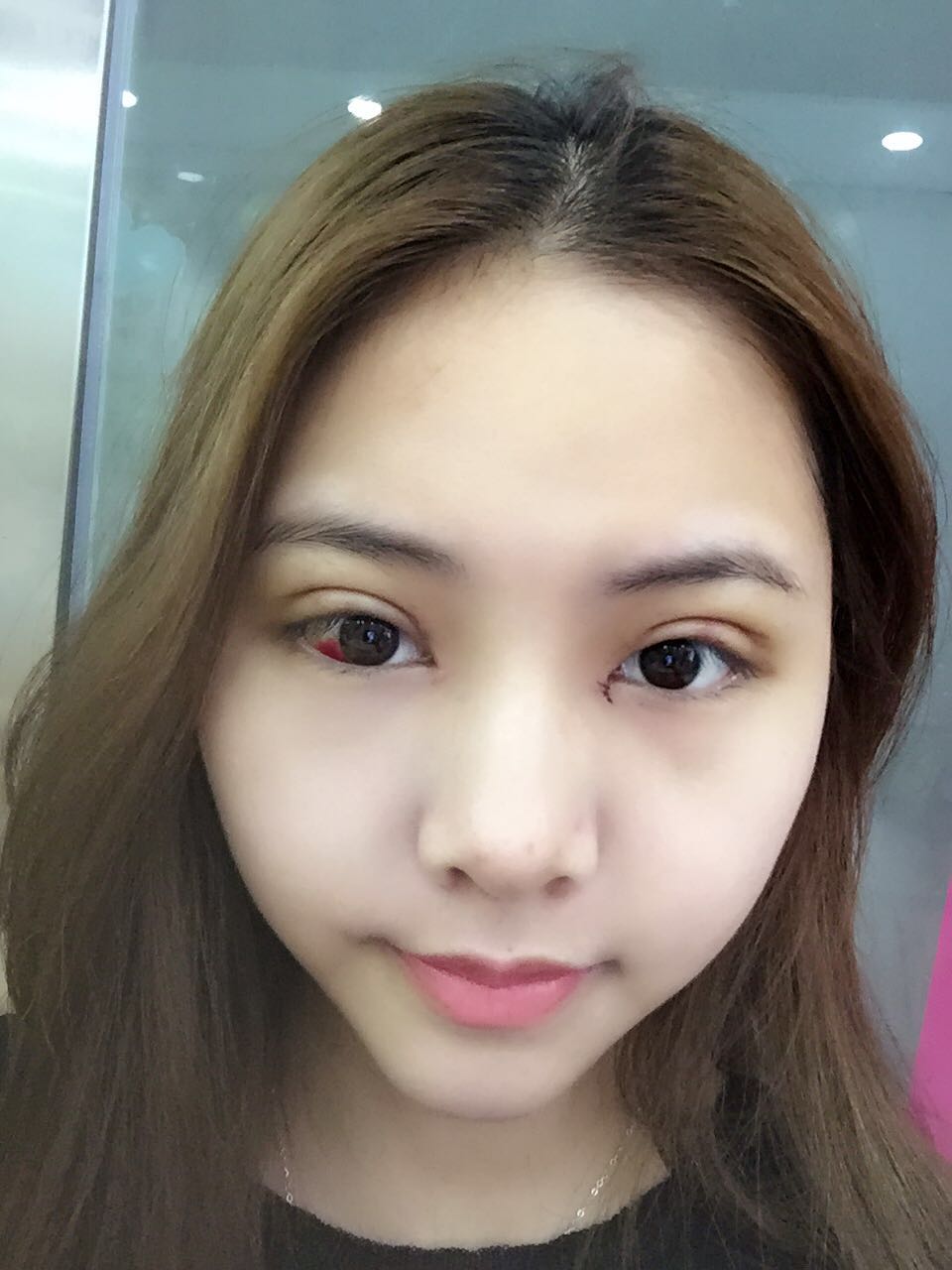 整形醫(yī)生徐長亮做切開雙眼皮案例效果對比圖