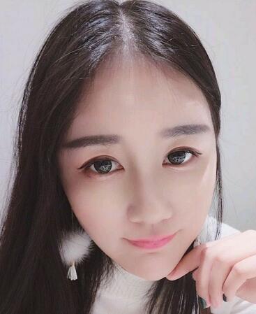 漢中韓美整形醫(yī)生常雙模假體隆鼻+耳軟骨墊鼻尖真實案例效果圖