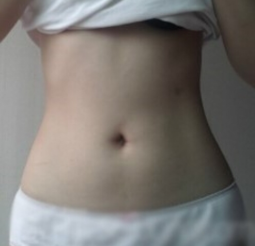 合肥壹加壹整形醫(yī)生周福田做腰腹吸脂案例
