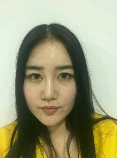 漢中韓美整形醫(yī)生常雙模假體隆鼻+耳軟骨墊鼻尖真實案例效果圖