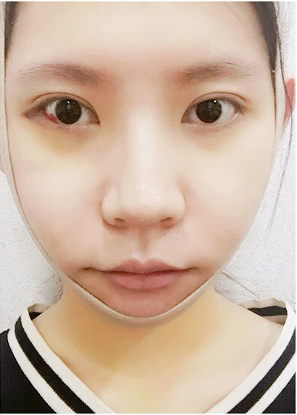  濟(jì)南安美醫(yī)療整形醫(yī)生李思思下頜角整形案例