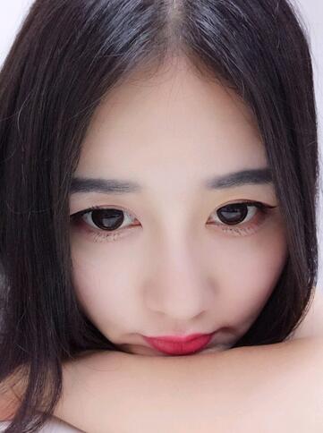 漢中韓美整形醫(yī)生常雙模假體隆鼻+耳軟骨墊鼻尖真實案例效果圖