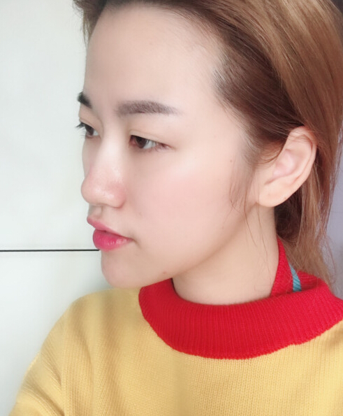 成都藝星陳遠琨醫(yī)生注射肉毒素瘦臉效果案例對比圖