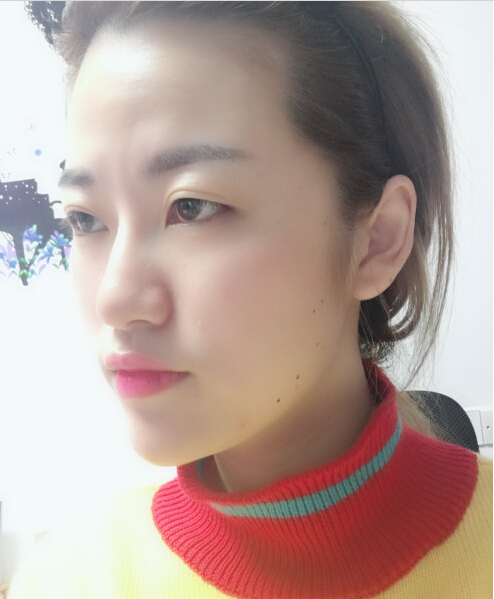 成都藝星陳遠琨醫(yī)生注射肉毒素瘦臉效果案例對比圖