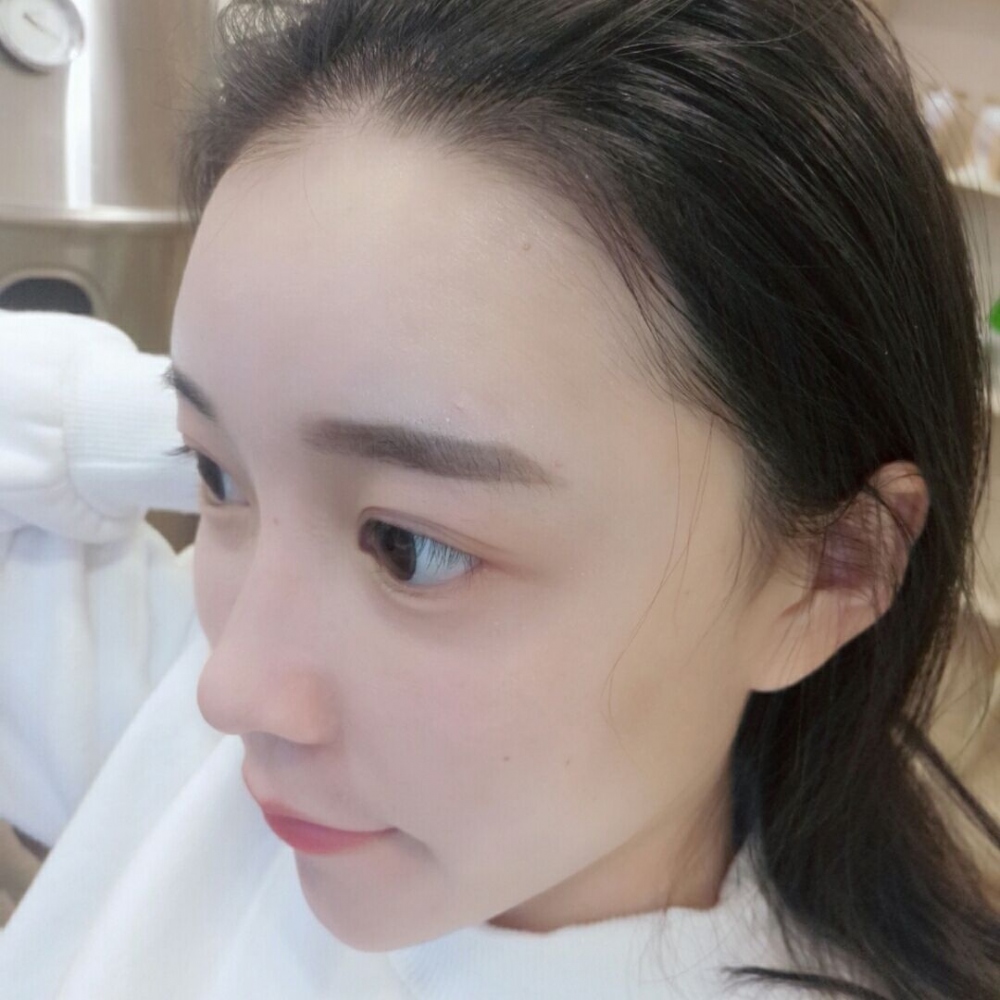 山西伊特雅整形醫(yī)生王鳳芹自體脂肪豐面頰+V-LINE瓜子臉手術(shù)案例效果圖 山西伊特雅整形醫(yī)生王鳳芹自體脂肪豐面頰+V-LINE瓜子臉手術(shù)案例效果圖